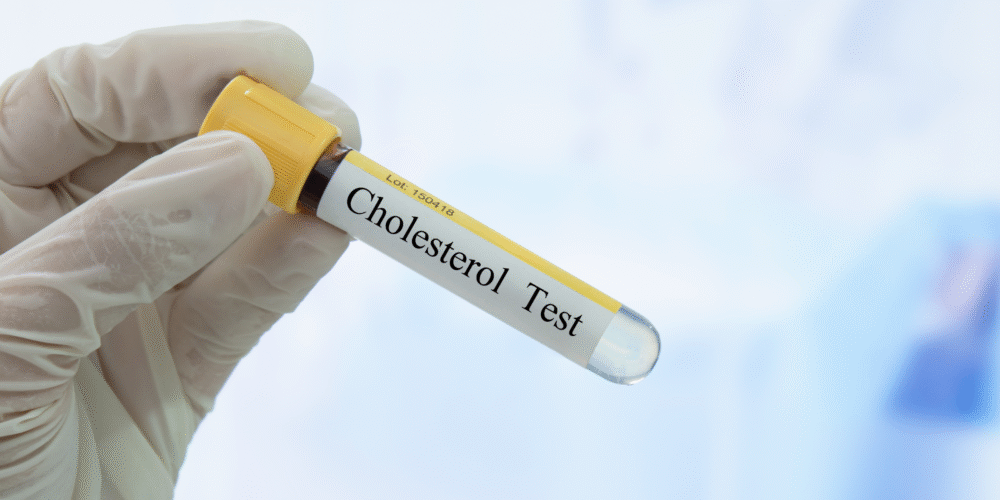 Book Your Cholesterol Test in London Today!