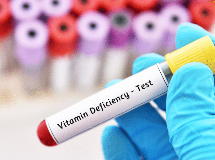 Book Your Vitamin Deficiency Test in London Today