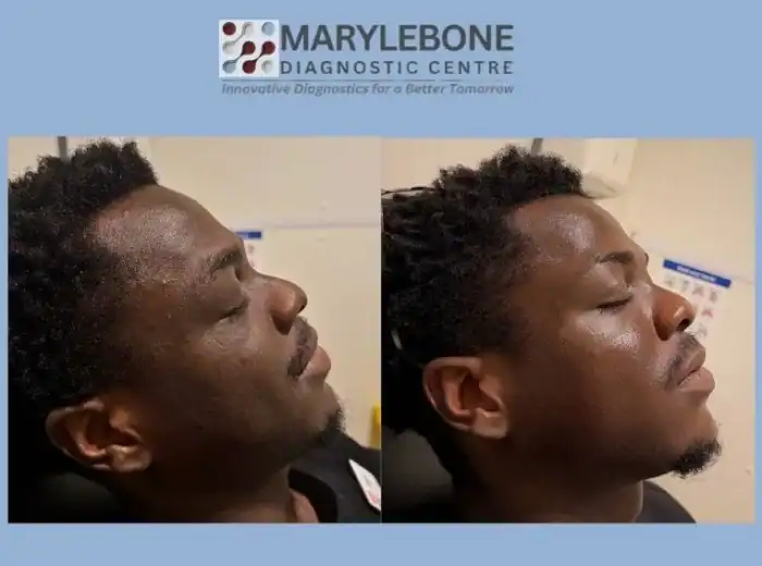 microneedling-before-and-after_1 (2)