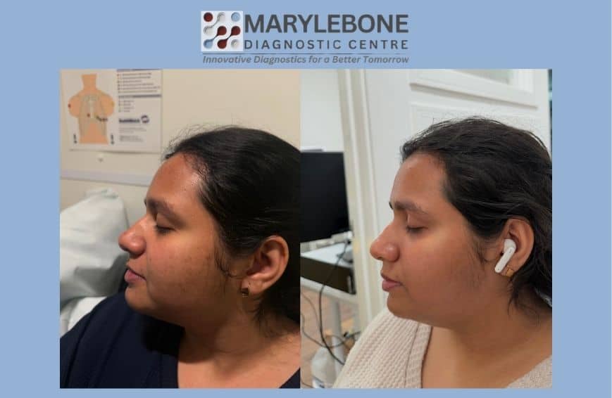 PRP Microneedling before and after result
