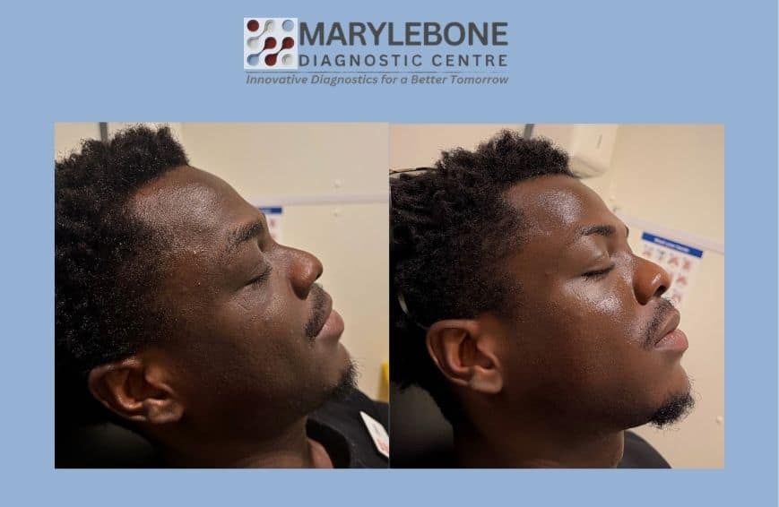 PRP Microneedling before and after result