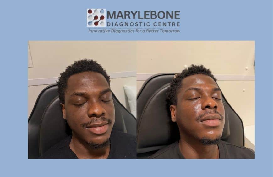 PRP Microneedling before and after result