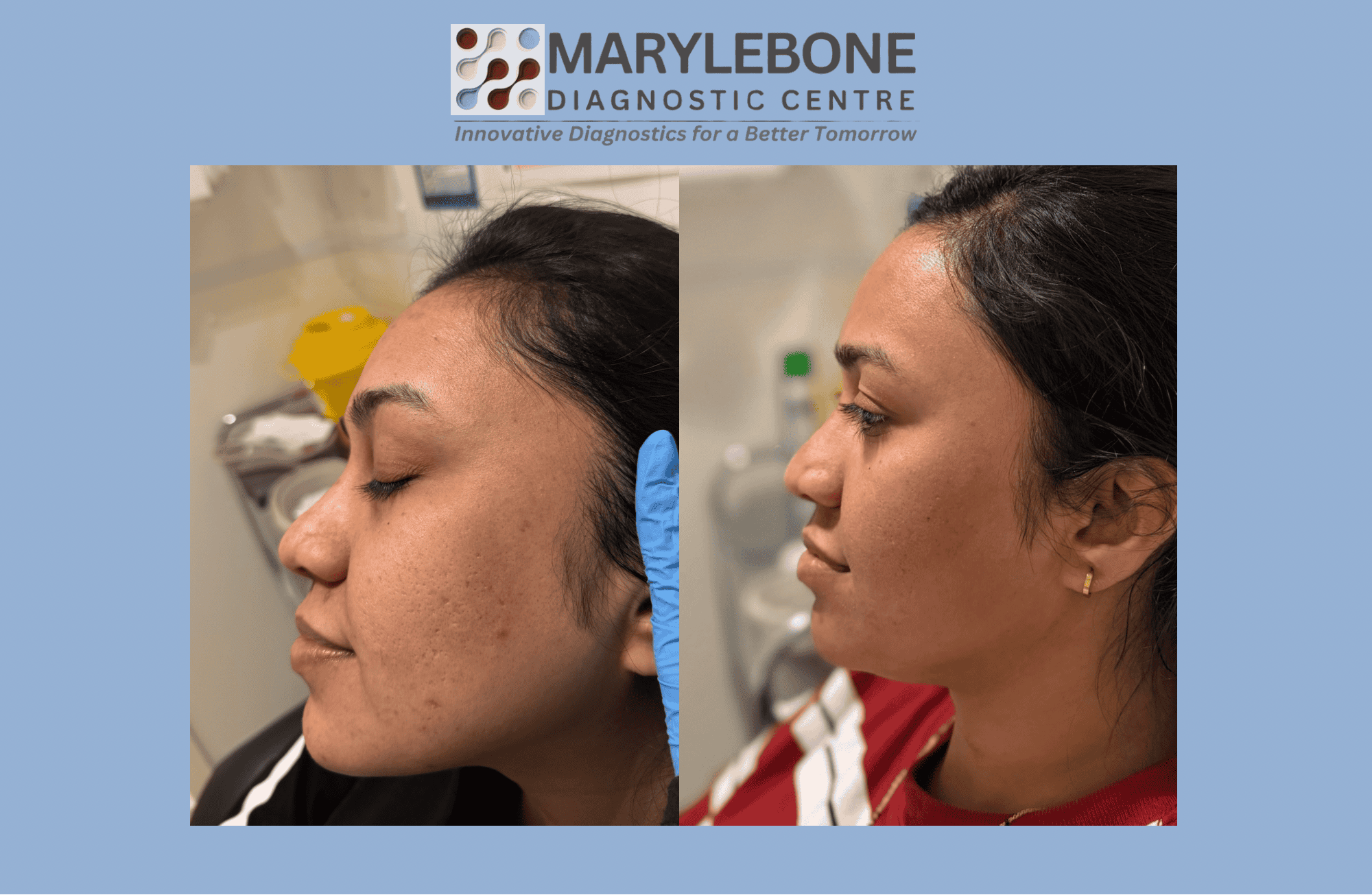 PRP Microneedling before and after result