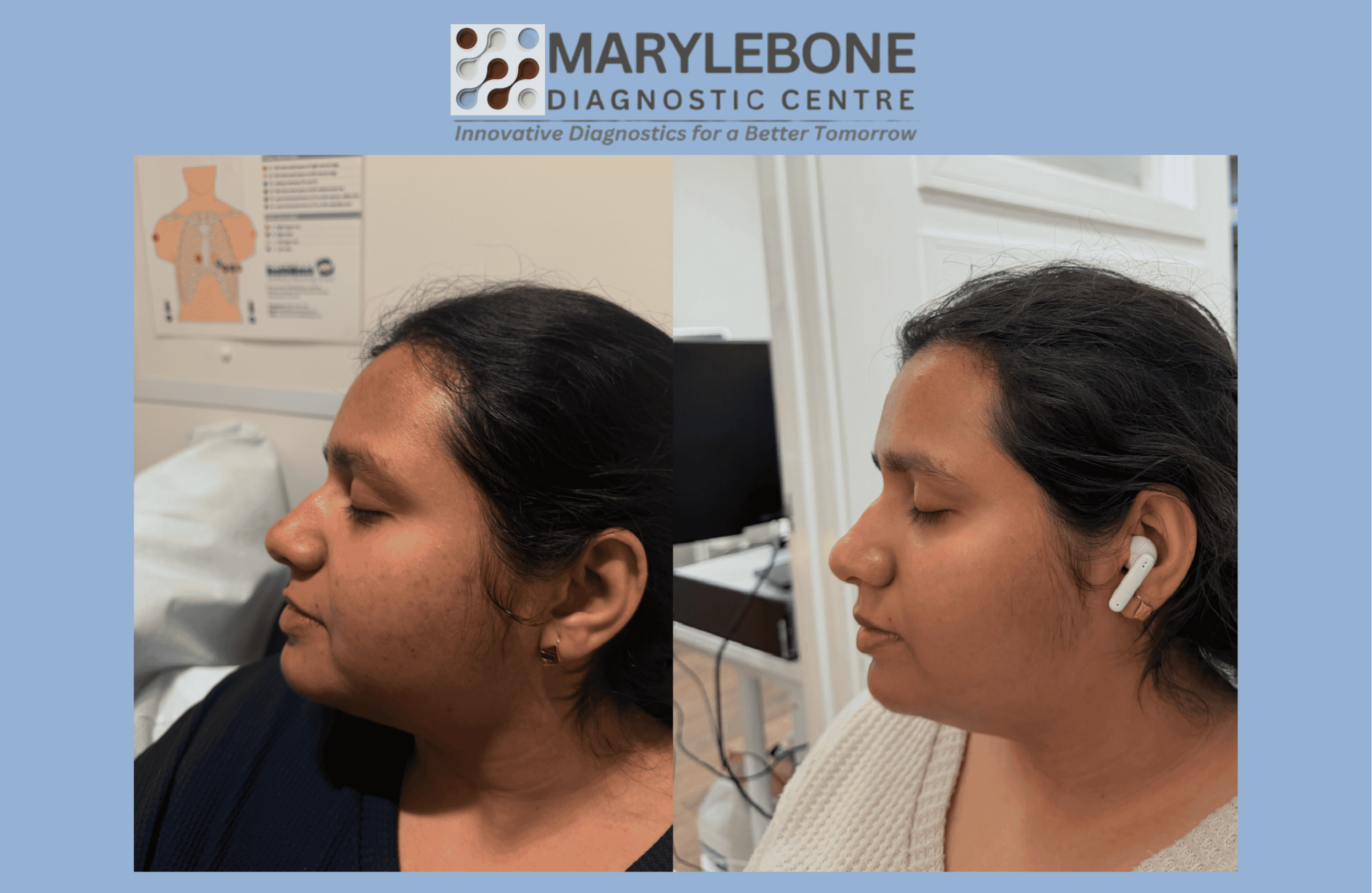 PRP Microneedling before and after result