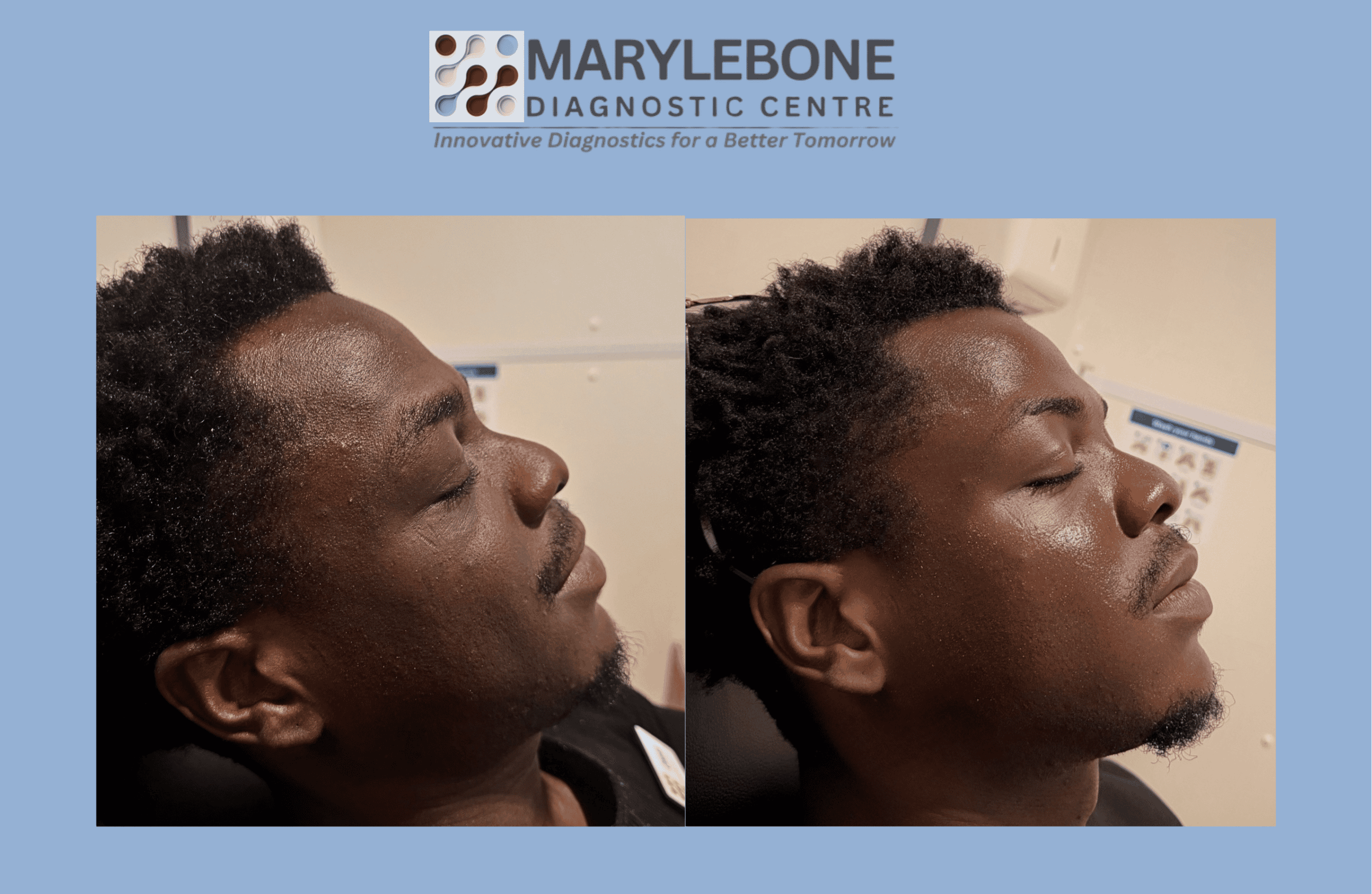 PRP Microneedling before and after result