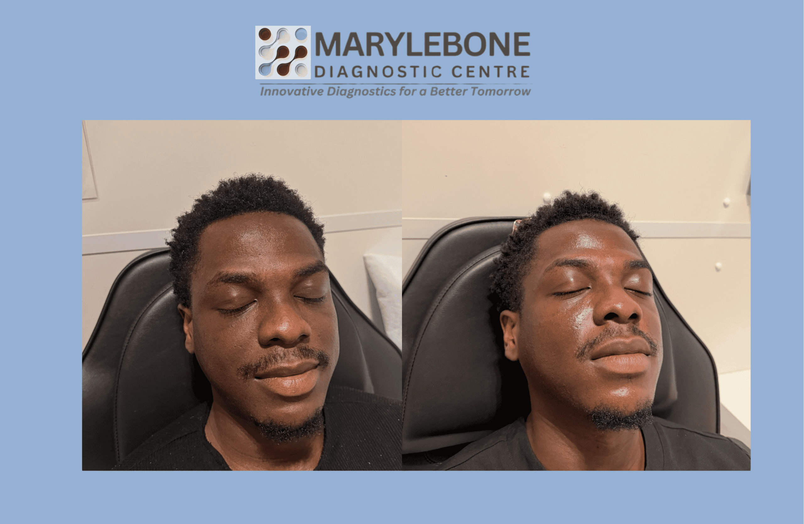 PRP Microneedling before and after result